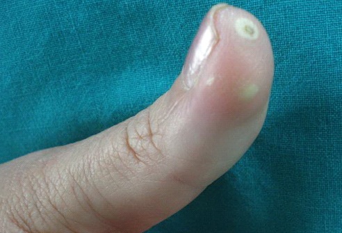 Limited Scleroderma