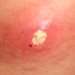 MRSA infection