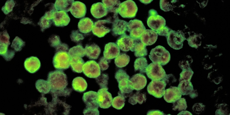 Naegleria Infection
