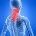 Neck Pain