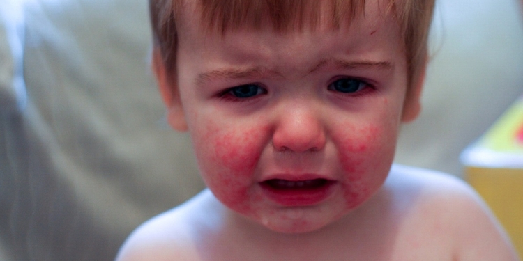 Parvovirus Infection