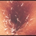 Pinworm Infection