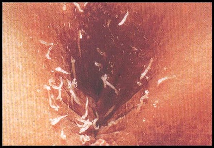 Pinworm Infection