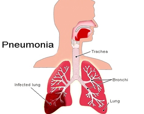 Pneumonia