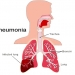 Pneumonia