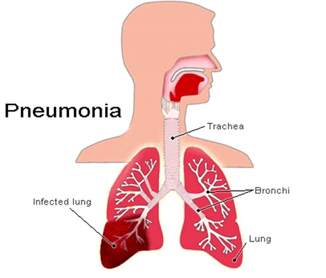 Pneumonia