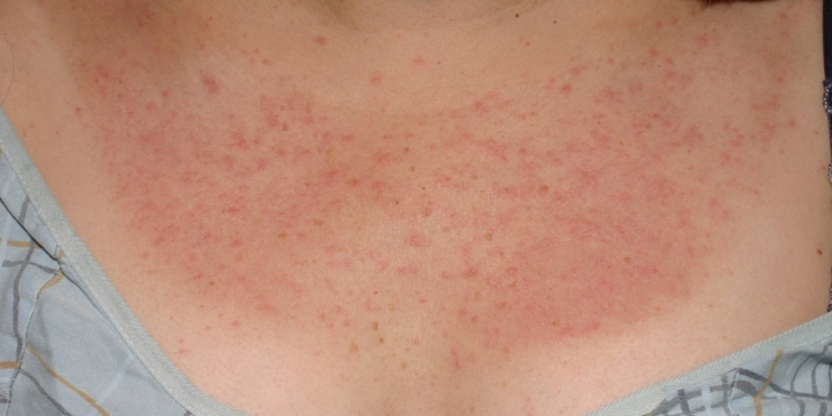 Polymorphous Light Eruption