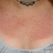 Polymorphous Light Eruption