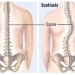 Scoliosis