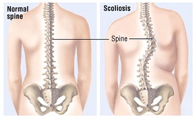 Scoliosis