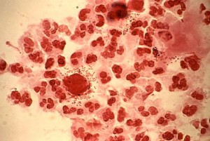 Trichomoniasis