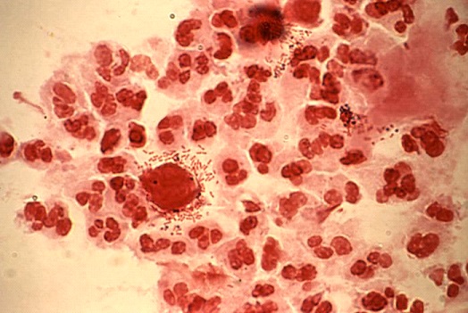 Trichomoniasis