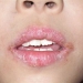Actinic Cheilitis