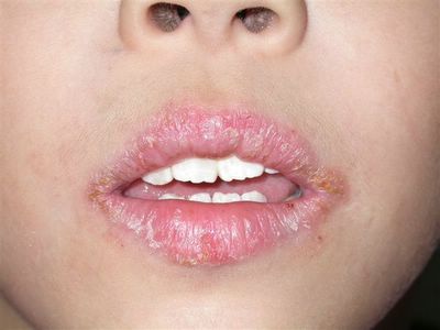 Actinic Cheilitis