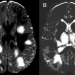 Acute Disseminated Encephalomyelitis