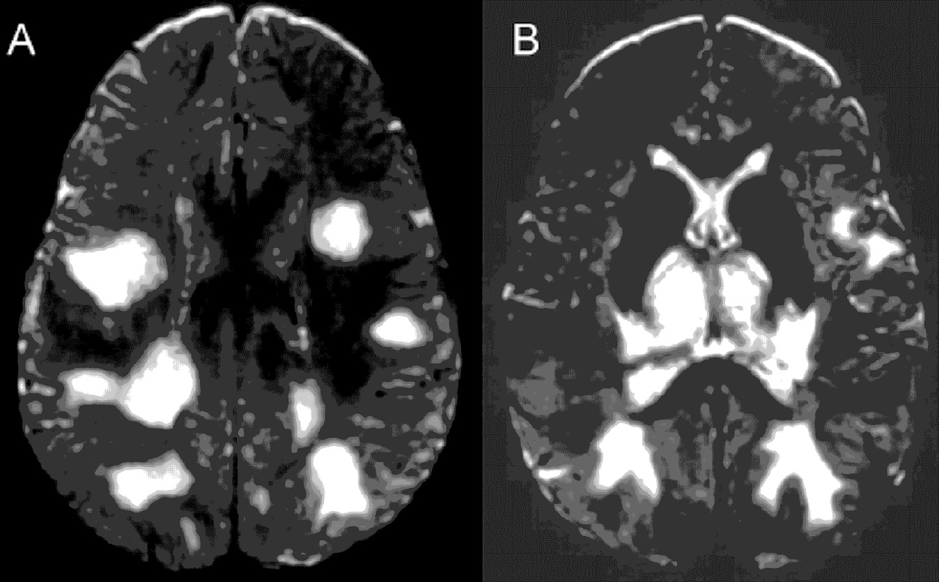 Acute Disseminated Encephalomyelitis