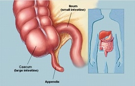 Appendicitis