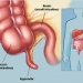 Appendicitis