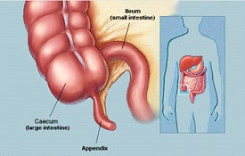 Appendicitis