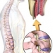 Arachnoiditis