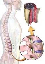 Arachnoiditis