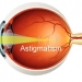 Astigmatism