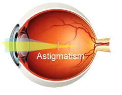 Astigmatism