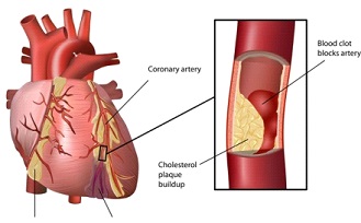 Atherosclerosis