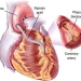 Coronary Artery Disease