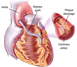 Coronary Artery Disease