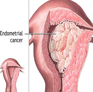 Endometrial Cancer