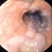 Esophageal Varices