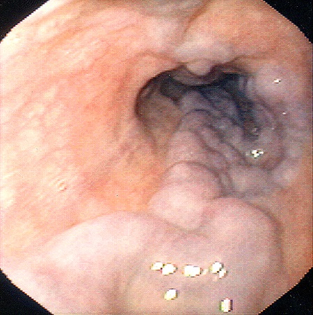 Esophageal Varices