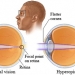 Farsightedness