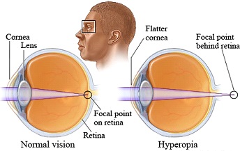 Farsightedness