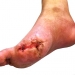 Gangrene