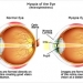 Myopia