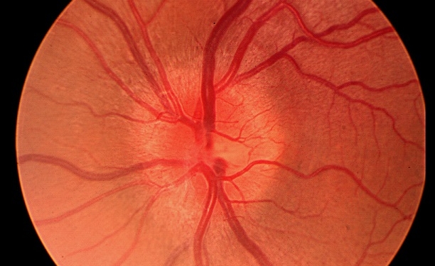 Optic Neuritis