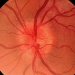 Optic Neuritis
