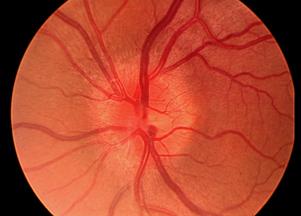 Optic Neuritis