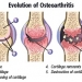 Osteoarthritis