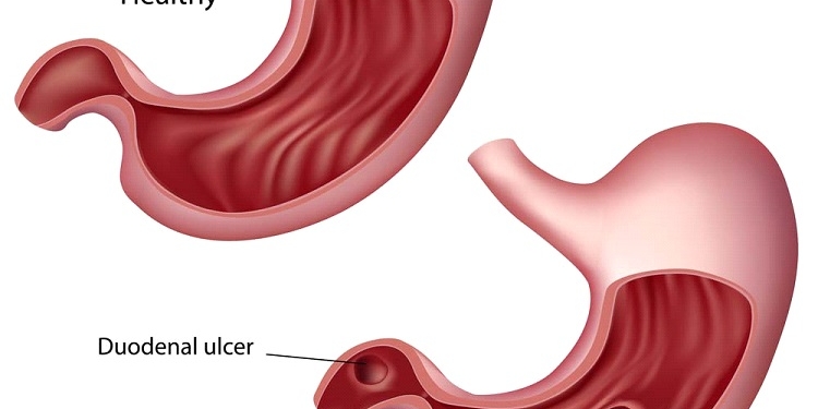 Peptic Ulcer