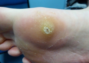Plantar Warts
