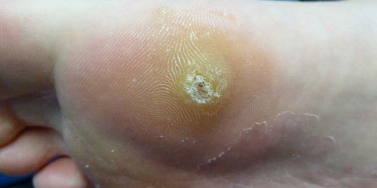 Plantar Warts