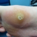 Plantar Warts