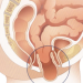 Posterior Prolapsed