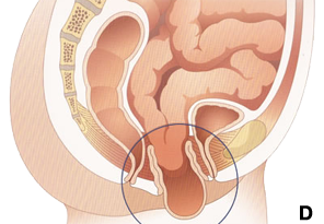 Posterior Prolapsed