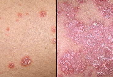 Psoriasis