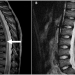 Transverse Myelitis