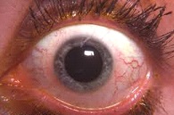 Uveitis